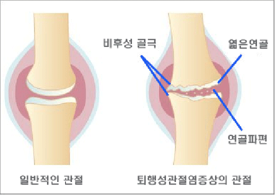 무릎 관절염 증상