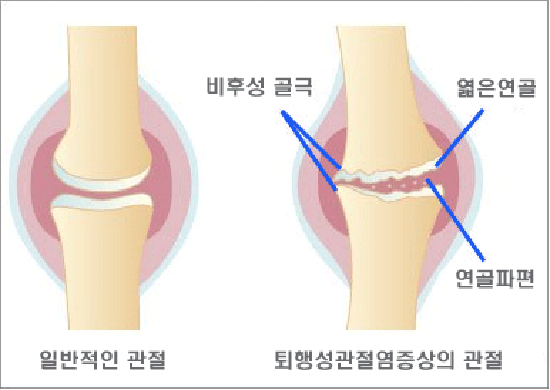 일반적 관절과 퇴행성관절염증상을 가진 관절의 차이를 나타낸 그림 네이버